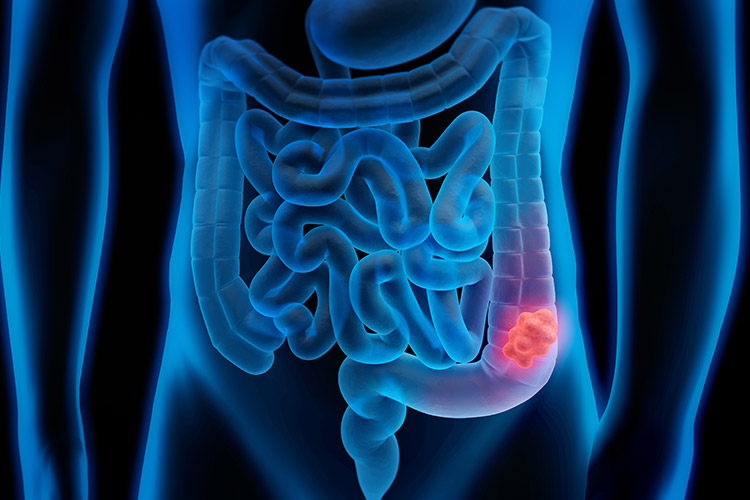 大腸ポリープのイメージ画像